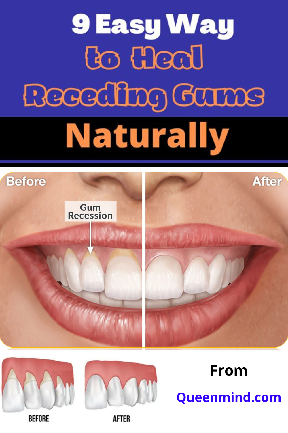 9 Easy Ways To Heal Receding Gums Naturally QueenMind 9 Easy Ways To Heal Receding Gums Naturally QueenMind