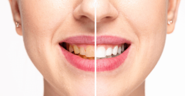 How to Whiten Teeth with Coconut Oil Naturally