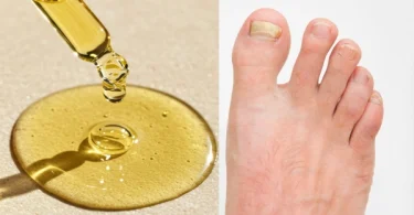 Tea Tree Oil for Toenail Fungus