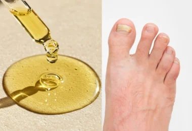 Tea Tree Oil for Toenail Fungus