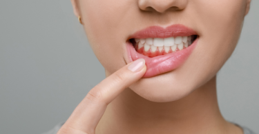 6 Powerful Ways to Regrow Receding Gums Naturally