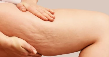 How to Use Coconut Oil to Reduce Cellulite