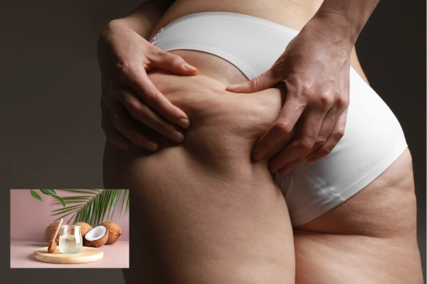 How to Use Coconut Oil to Reduce Cellulite