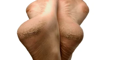 Best Essential Oils for Cracked Heels
