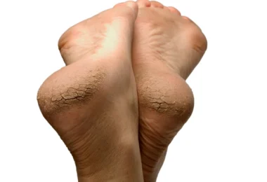 Best Essential Oils for Cracked Heels