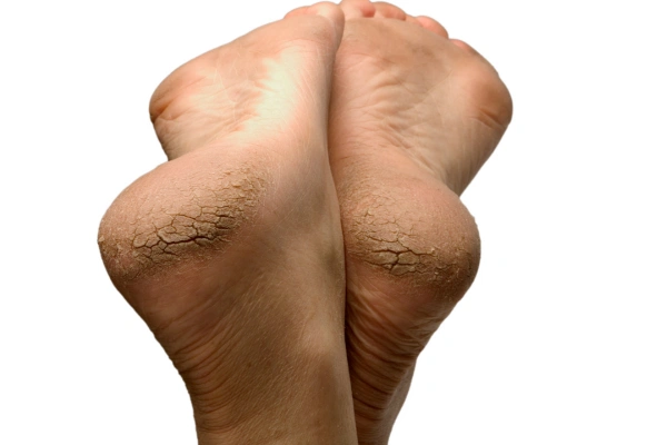 Best Essential Oils for Cracked Heels